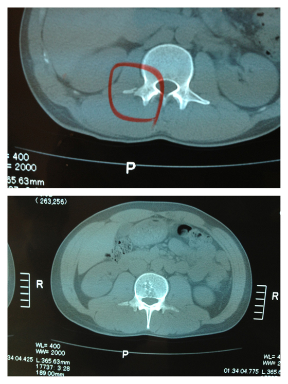 人類の進化とともに退化していった骨がこの横突起骨。バッチリ2本折れてました。